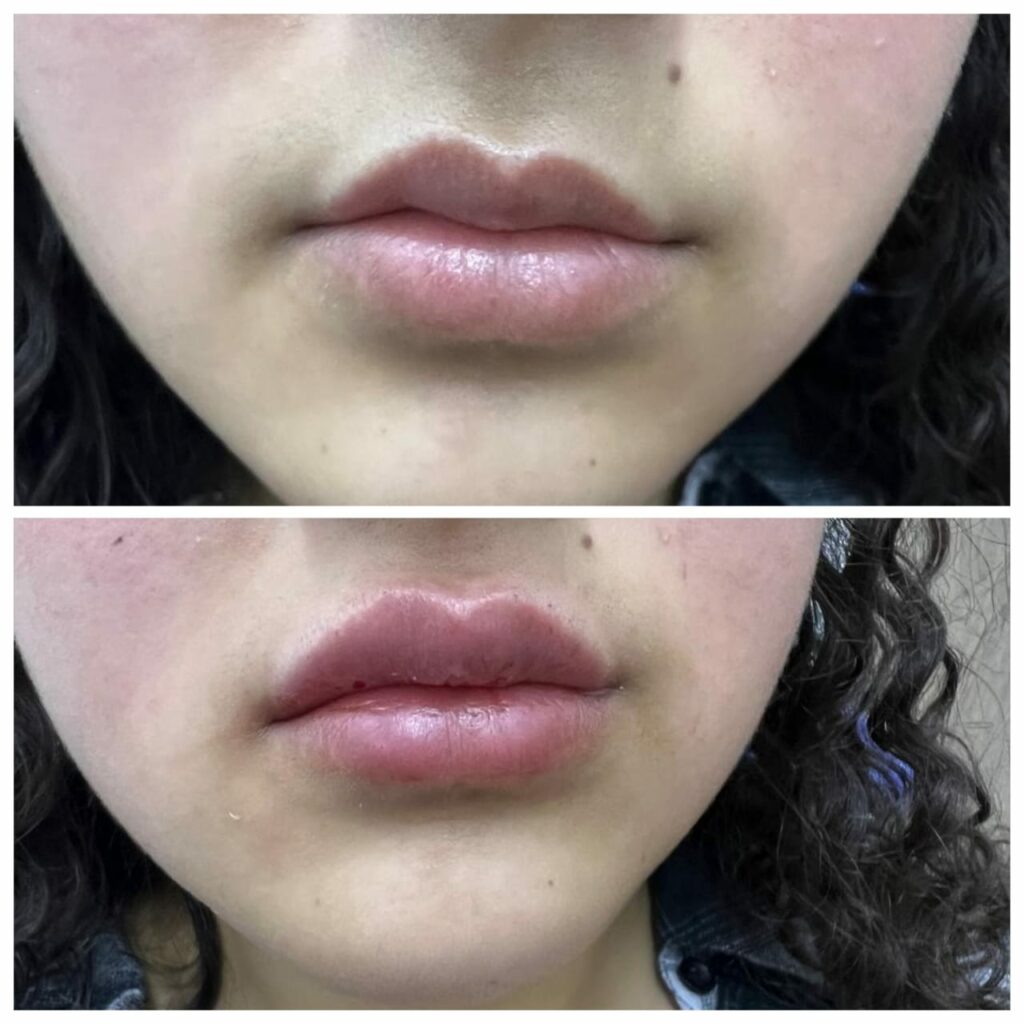 حقن الهيالرونيك للوجه والشفايف